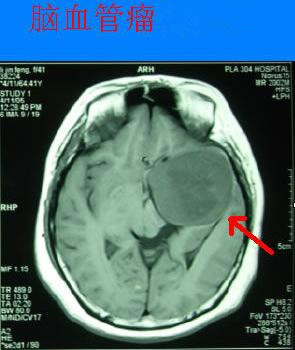 脑血管瘤